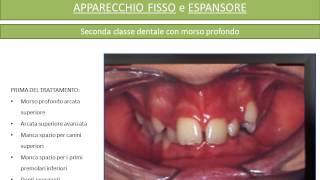 Apparecchio fisso e Espansore Prima e Dopo [upl. by Francisca]