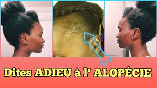 🇨🇮61• FINI L ALOPÉCIE grâce à ces ASTUCES  POUSSE ET VOLUME DES TEMPES  Cheveux crépus  Valèh Té [upl. by Brander163]