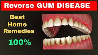 Gums Disease Home Remedies that fix your Gum Very fast [upl. by Annhoj]