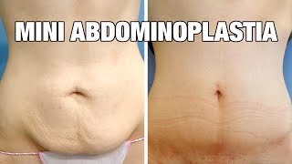 Mini Abdominoplastia antes y después  Testimonio Cristina [upl. by Lillywhite]