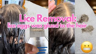 Nits was glued to the hair l 2 hr lice removal l small business explore hair lice [upl. by Martinez]