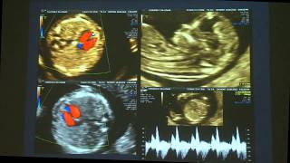 Ecocardiografía del I trimestre  Prof Ignacio Montaño [upl. by Mij]