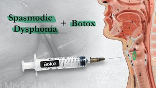 Spasmodic Dysphonia  When Botox Disappoints  Part 2 [upl. by Ennis332]