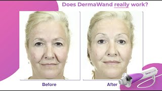 DermaWand Pro  Reduces Wrinkle Appearance in 1 WEEK Clinicallyproven radiofrequency device [upl. by Bernardine413]