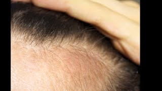 Regrow hair 100 and Stop hair fall Stop hair grey with simple tips [upl. by Aineles]