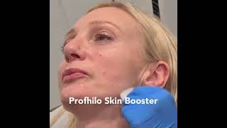 Profhilo injectable moisturiser demo at City Skin Clinic shortsvideo beauty skincare profhilo [upl. by Adle346]