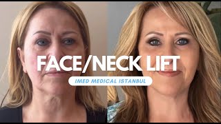 Face amp Neck lift by IMed Medical Istanbul [upl. by Celene250]