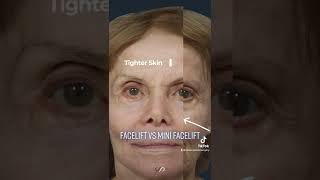 Facelift vs Mini Facelift Understanding the Difference  Dr David Stoker [upl. by Madonna403]