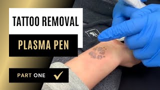 Plasma Tattoo Removal amp Salt Osmosis  Part 1 [upl. by Dumond]