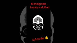 Meningioma heavily calcified shorts trending education [upl. by Terrel]