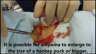 Office Procedure Lipoma Removal [upl. by Henghold]