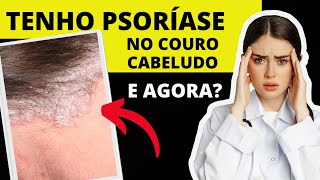 PSORÍASE NA CABEÇA COMO TRATAR SAIBA [upl. by Cilurzo]