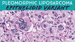 Pleomorphic Liposarcoma Epithelioid Variant [upl. by Perron]