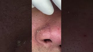 Big Cystic Acne Blackheads Extraction Blackheads amp Milia Whiteheads Removal Pimple Popping shorts [upl. by Kerge]