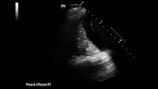 Parapneumomic Effusion Group A Strep Pyogenes Sepsis [upl. by Latsyek]