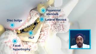 NYNJ Abstract  Mild Treatment Outcomes in the Presence of Foraminal Narrowing [upl. by Zigmund]