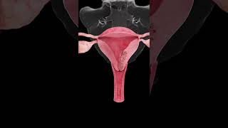 🎗️ Understanding Endometrial Cancer A Growing Concern for Women’s Health 🎗️ [upl. by Koblick516]