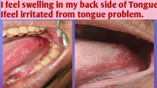 My back side of tongue bump enlargedI feel irritation from my back side of tongueTongue bump kya h [upl. by Neelrahs502]