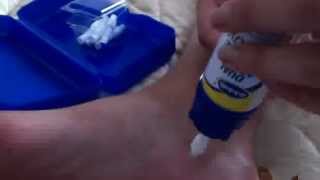 Dr Scholls Dual Action Freeze away wart remover how to for large warts [upl. by Nylaj371]