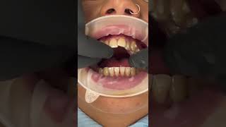 Getting INVISALIGN for the first time shorts invisalign orthodontist [upl. by Yrtnahc]