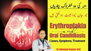 What Is Erythroplakia amp Oral Candidiasis  Causes Symptoms Treatment [upl. by Koehler]