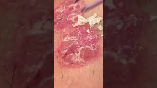 Psoriasis Scab Peel 3 [upl. by Anitaf]