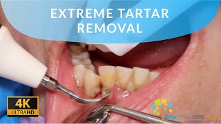 EXTREME TARTAR REMOVAL satisfying dental dentist [upl. by Rutherfurd610]