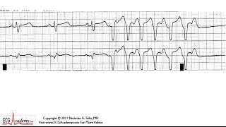 ECG Interpretation Tutorial  ChalkTalk 01 Intermediate Level [upl. by Eibrab764]