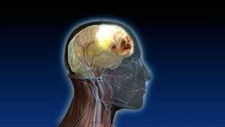 What is a Subdural Hematoma or Blood on the Brain [upl. by Aimo]