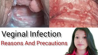 Veginal Infection  How To Relief From Infection [upl. by Kassey]