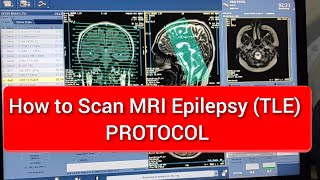 Brain Epilepsy MRI scan Protocol Positioning amp Planning [upl. by Malan]