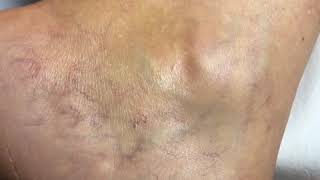 Sclerotherapy Treatment of our Bulgarian Patient [upl. by Ecirtael346]