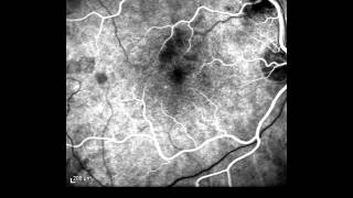 Angiogram of right eye [upl. by Hamilah]