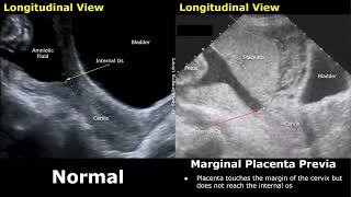 Obstetric Ultrasound Normal Pregnancy Vs Placenta Previa  LowLying Marginal Partial Complete [upl. by Jerald952]