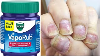 The ultimate solution for Nail Psoriasis Vickss Vaporub revealed [upl. by Hussey]