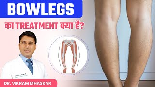 Bow Legs का Treatment क्या है  Bow Legs को कैसे ठीक किया जाता है  Dr Vikram Mhaskar [upl. by Ardeahp]