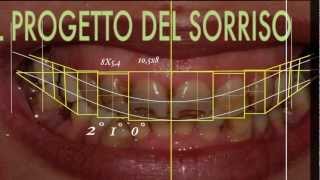 Cambiare laspetto del sorriso con faccette dentali  SMILE DESIGN [upl. by Rhetta]