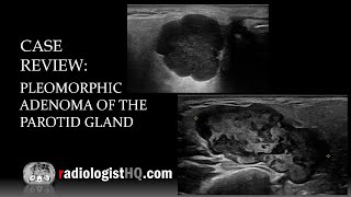 Ultrasound of Pleomorphic Adenoma of the Parotid Gland [upl. by Elletnahc]