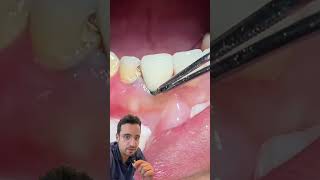 Un FIL dans la DENT  Technique de RÉTRACTATION Gingivale dentiste dent dentaire [upl. by Ayiotal]