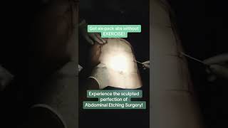 The Body Sculptor Abdominal Etching by Dr Romeo V Bato [upl. by Lux]