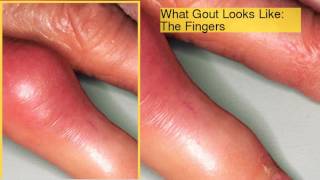 Gout Pictures Causes Symptoms and Treatments of Gout [upl. by Elohcim32]