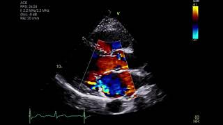 Video 1 Parasternal long axis view with color doppler [upl. by Nwahsem]