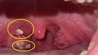 how to get rid of tonsil stones in throat without touching them [upl. by Bausch369]