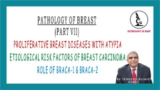 Proliferative Breast Diseases with Atypia Etiological Risk Factor of Breast CA Role BRACA1 amp BRACA2 [upl. by Aihsar193]