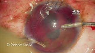 Corneo Scleral tear with iris prolapse amp Hyphema in a One eyed patient  Principles of Surgery [upl. by Ezri]