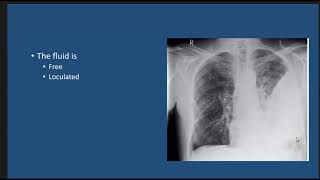 Thoracic Empyema case discussion [upl. by Krause]