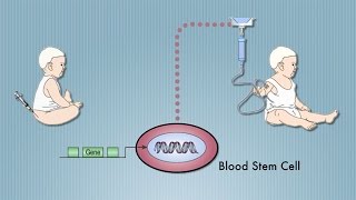 Stem Cell Cure for quotBubble Babyquot Disease SCID Pioneered by UCLAs Don Kohn [upl. by Mctyre]