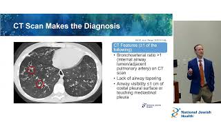 Overview of Bronchiectasis [upl. by Ayanat]