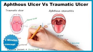 Aphthous ulcerstomatitis Vs Traumatic ulcer [upl. by Askwith]