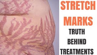 how to get rid of stretchmark fast natural and permanently at home [upl. by Gelhar]